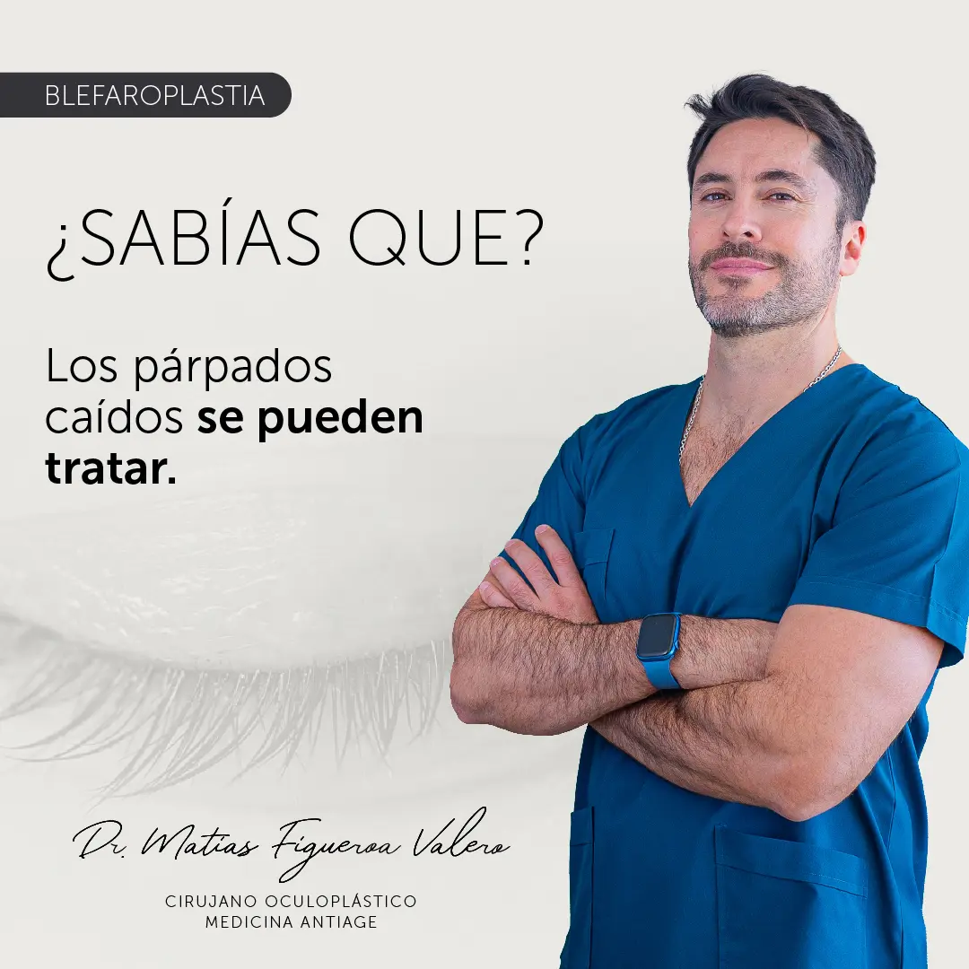 Blefaroplastia Párpados Caídos - Dr. Matías Valero
